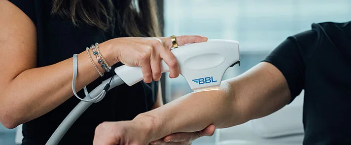 A practitioner uses a BBL laser device on a patient's arm during a skin treatment session.