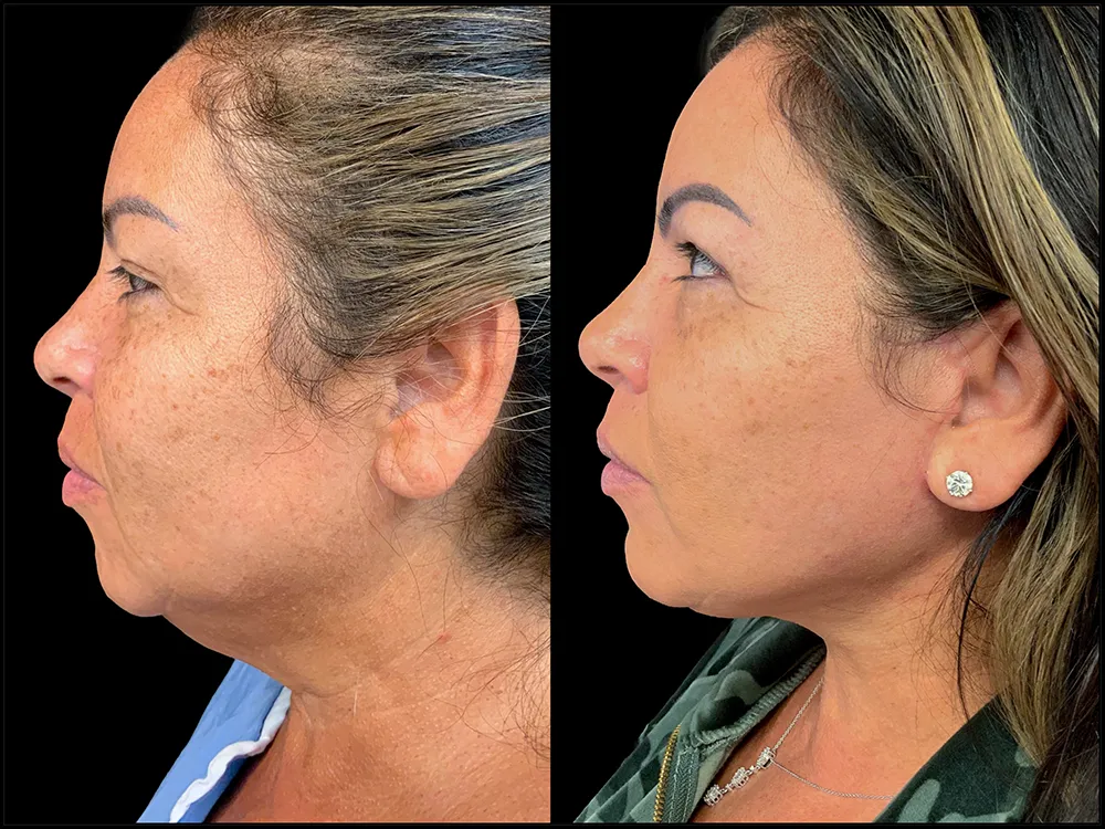 facelift-1-B&A