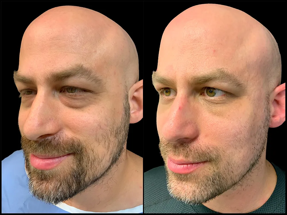 lower-bleph-01_1- B&A