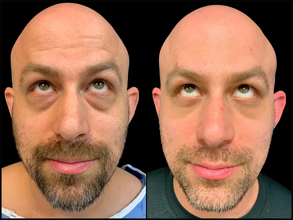 lower-bleph-01_3- B&A