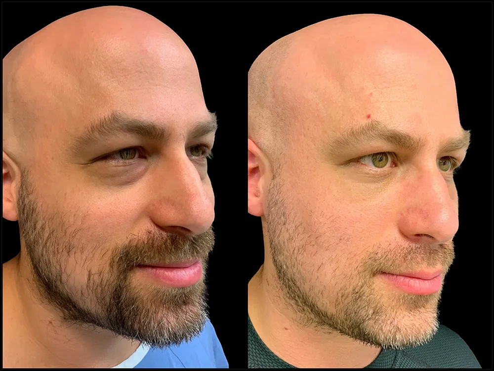 lower-bleph-01_4- B&A