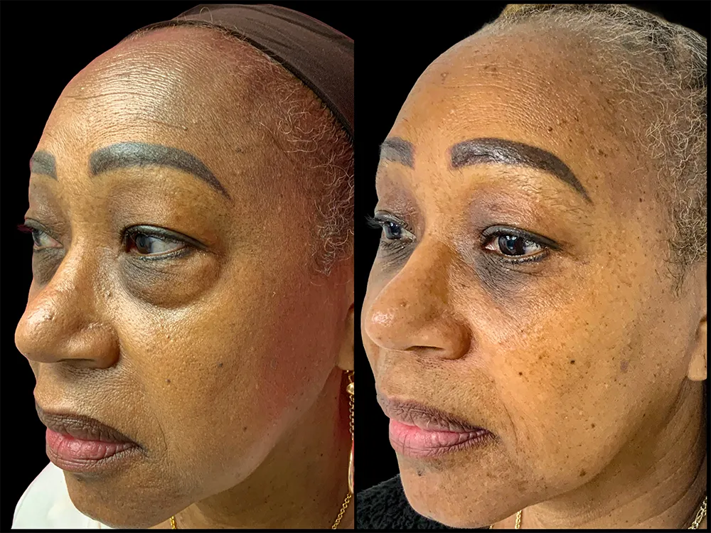 lower-bleph-02_1-B&A