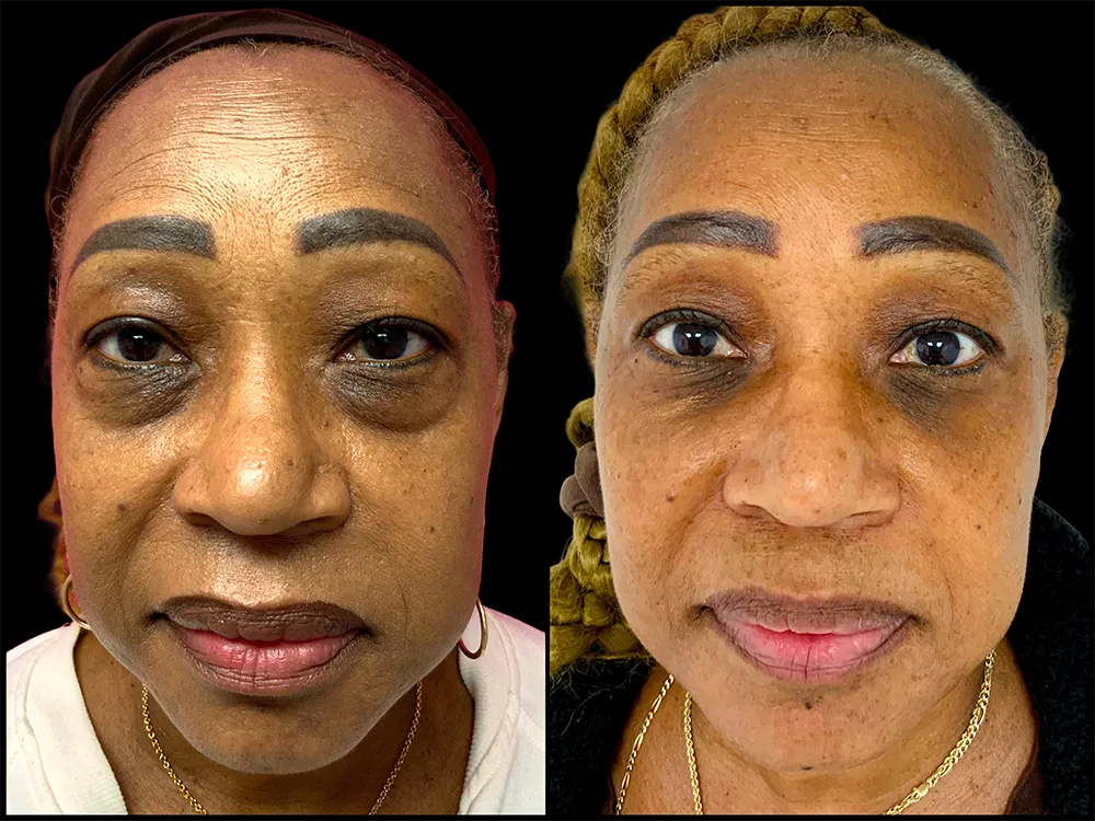 lower-bleph-02_2-B&A