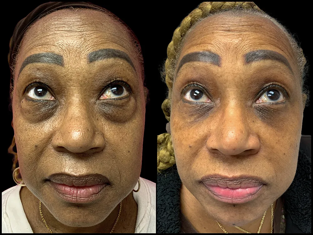 lower-bleph-02_3-B&A