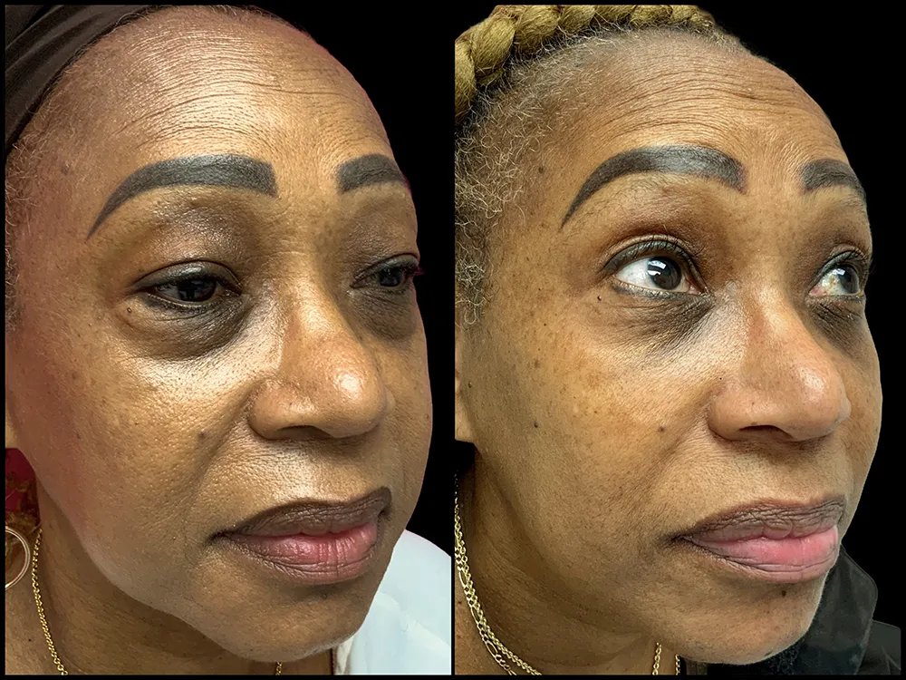 lower-bleph-02_4-B&A