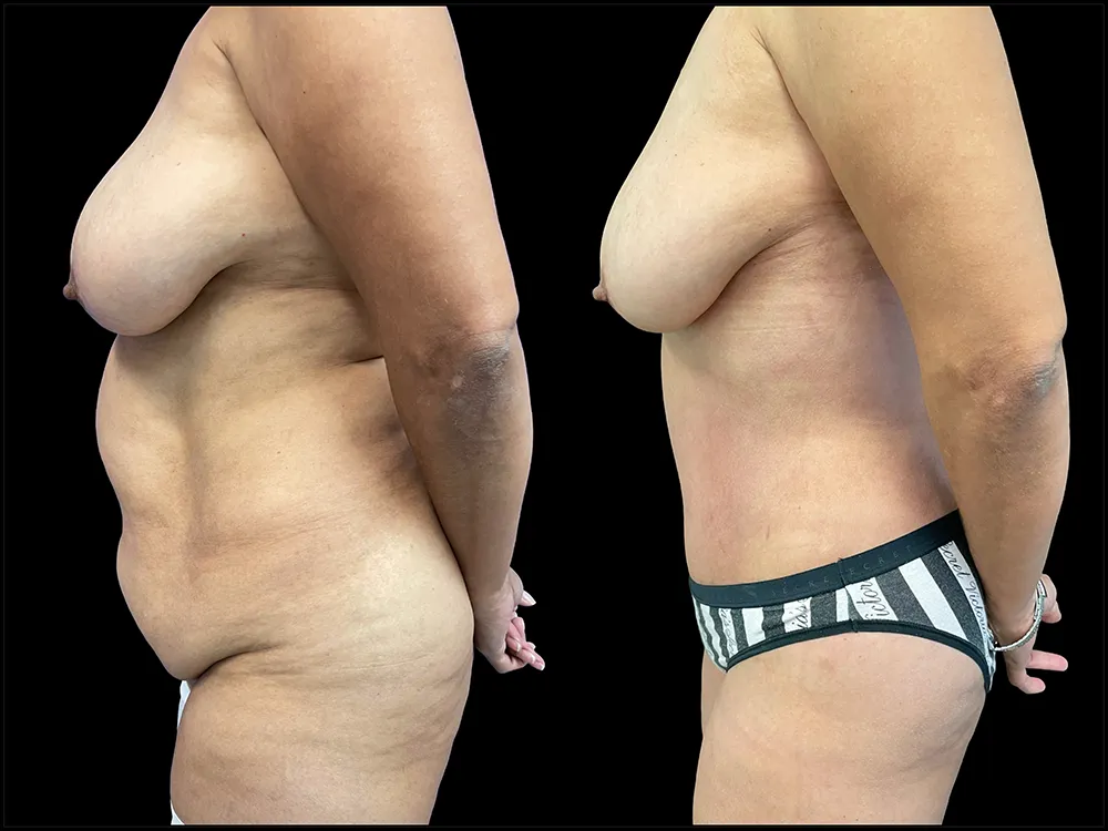 tummy-tuck-1-B&A