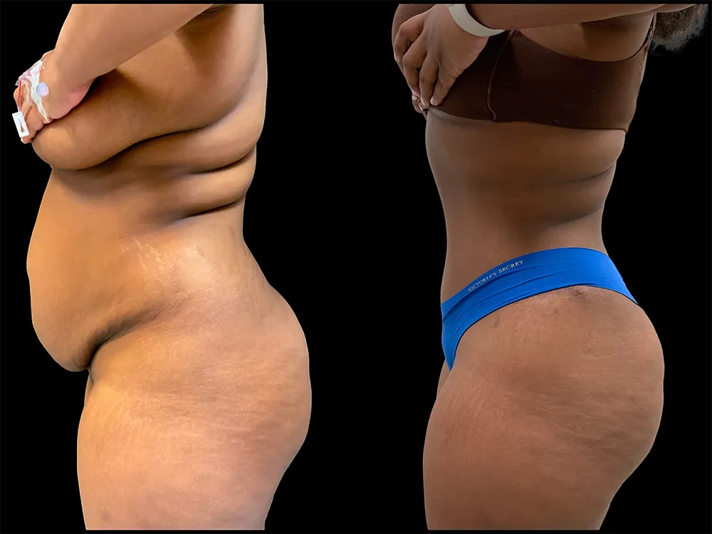 tummy-tuck-1-B&A