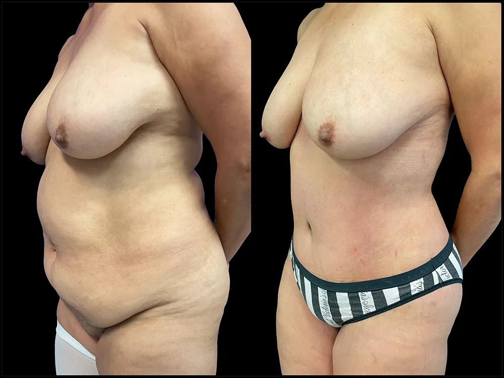 tummy-tuck-2-B&A