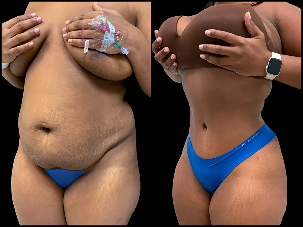 tummy-tuck-2-B&A