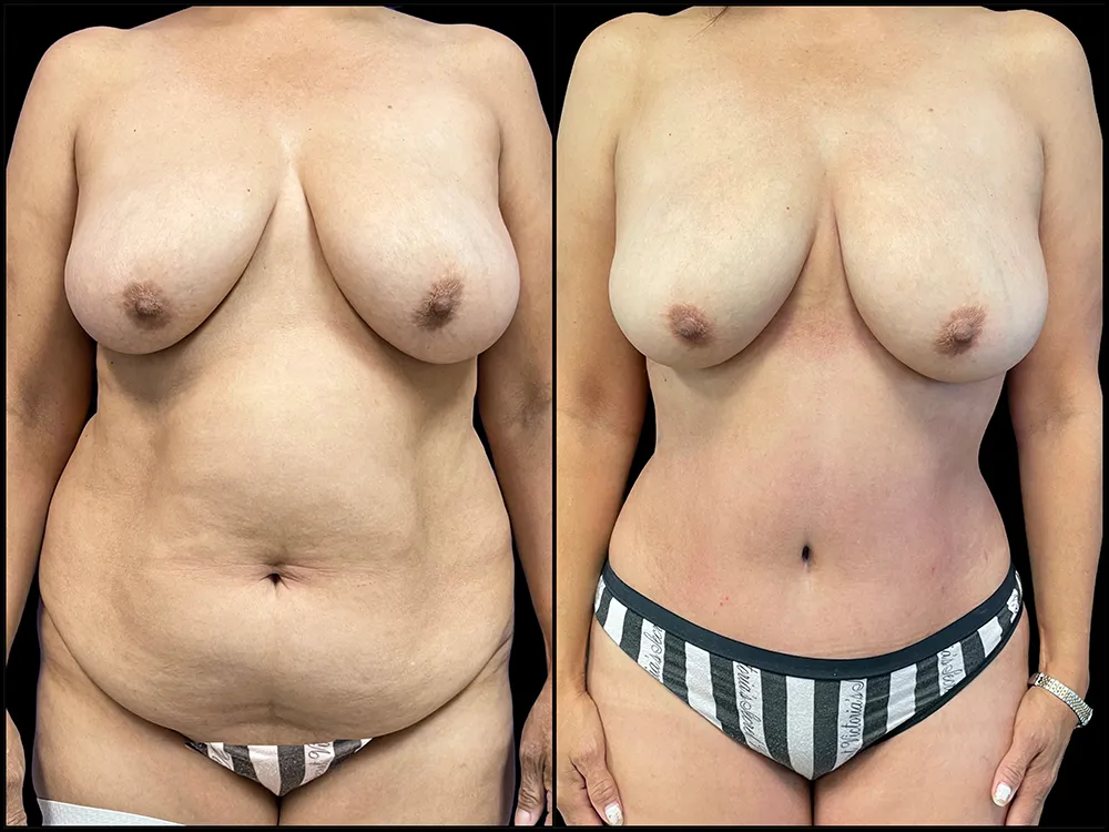 tummy-tuck-3-B&A