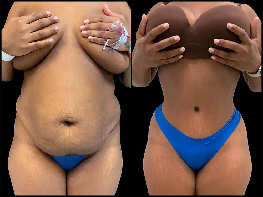 tummy-tuck-3-B&A