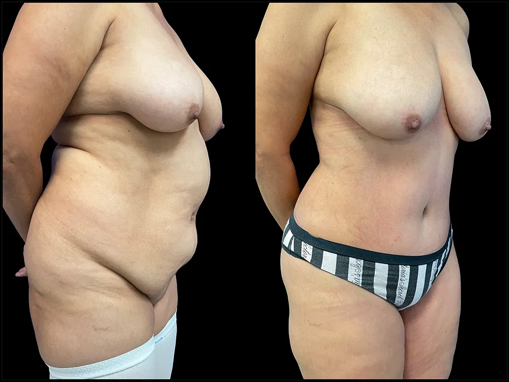 tummy-tuck-4-B&A