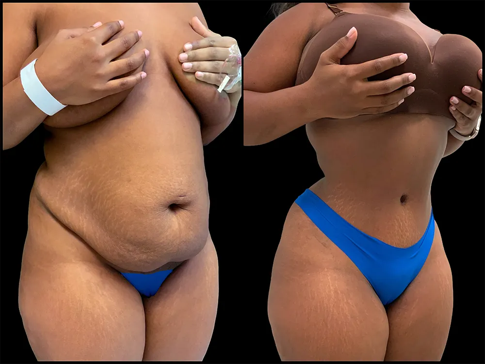 tummy-tuck-4-B&A