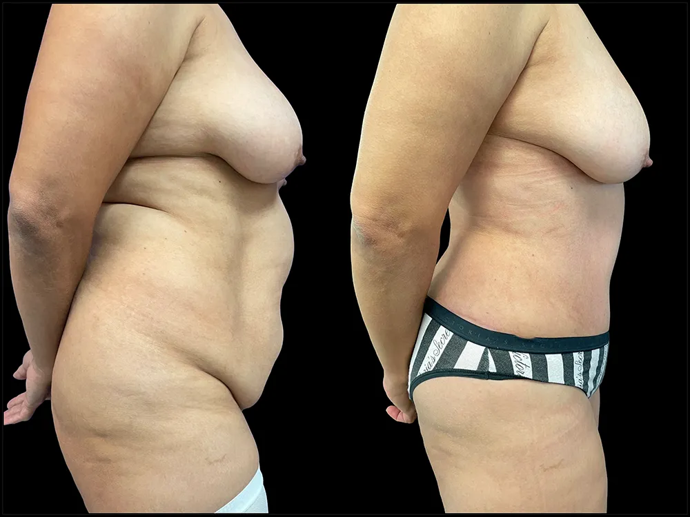 tummy-tuck-5- B&A