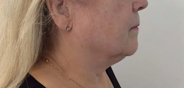ultherapy-prime-ultra_after